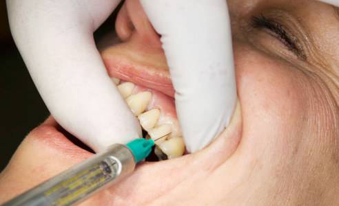 Основные виды местной анестезии в стоматологии