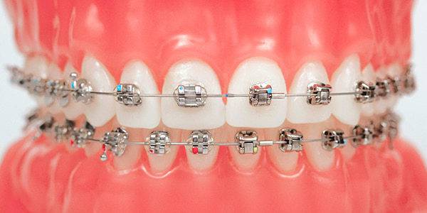 Сколько стоят брекеты для зубов и как цены зависят от брекет-системы?