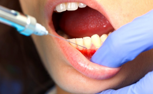 Сколько действует анестезия зуба?