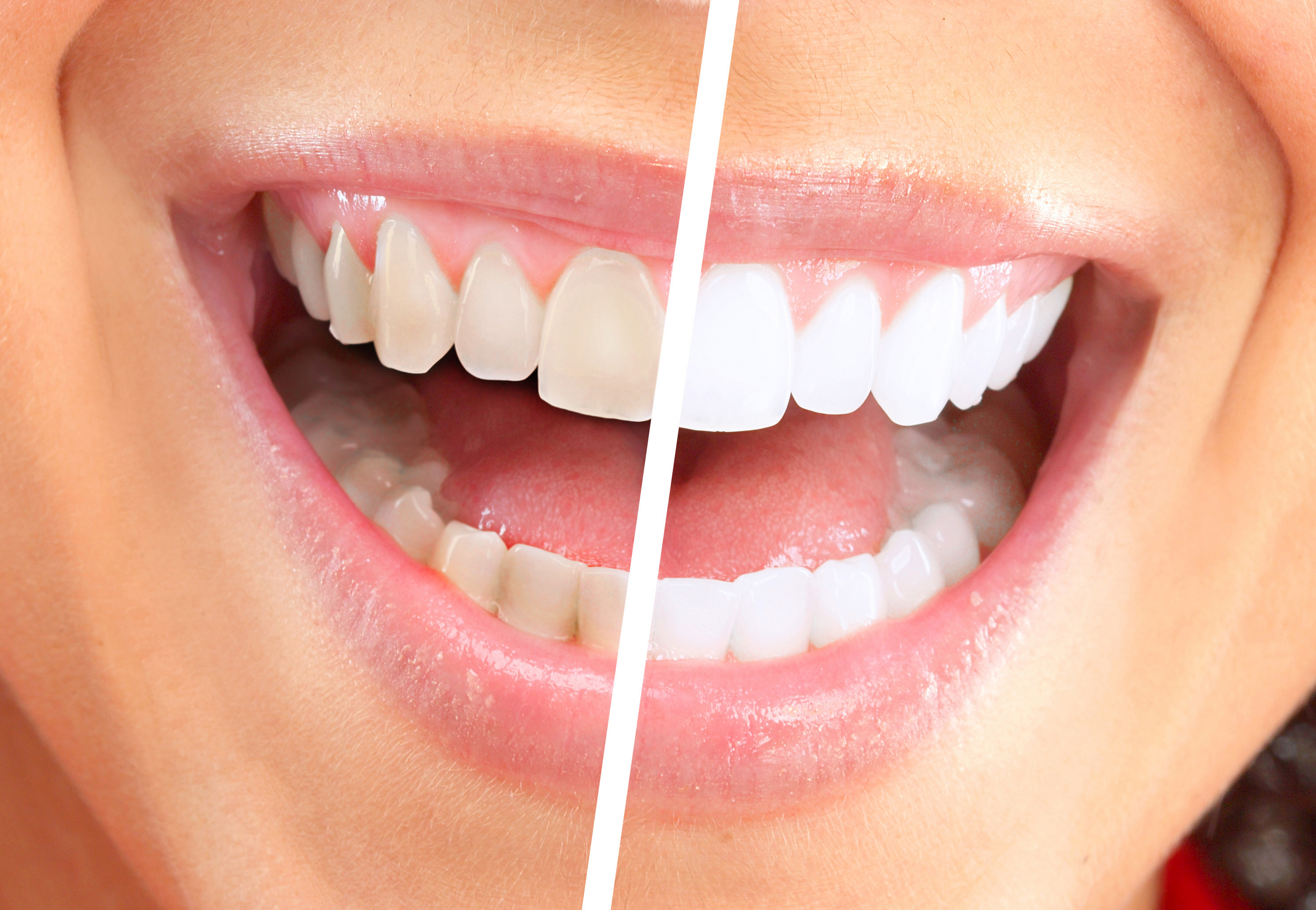 Как отбелить зубы перекисью водорода и содой