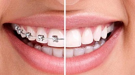 Зубы станут кривыми, если снять брекеты – Миф № 1!