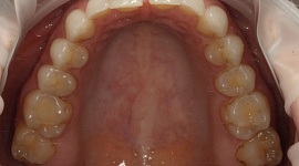Лечение диастемы зубов